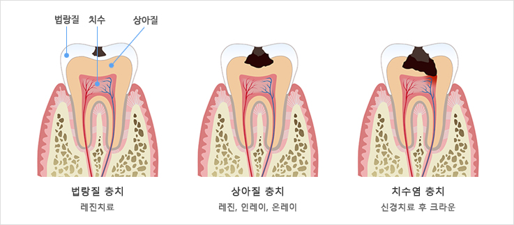 충치의 진행 과정
