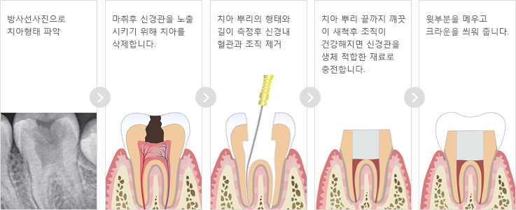 근관치료의 순서